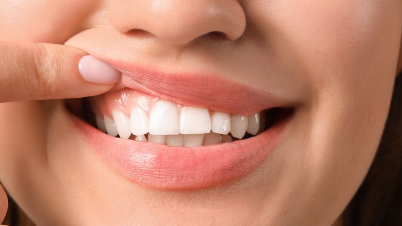 Womans teeth revealing gums